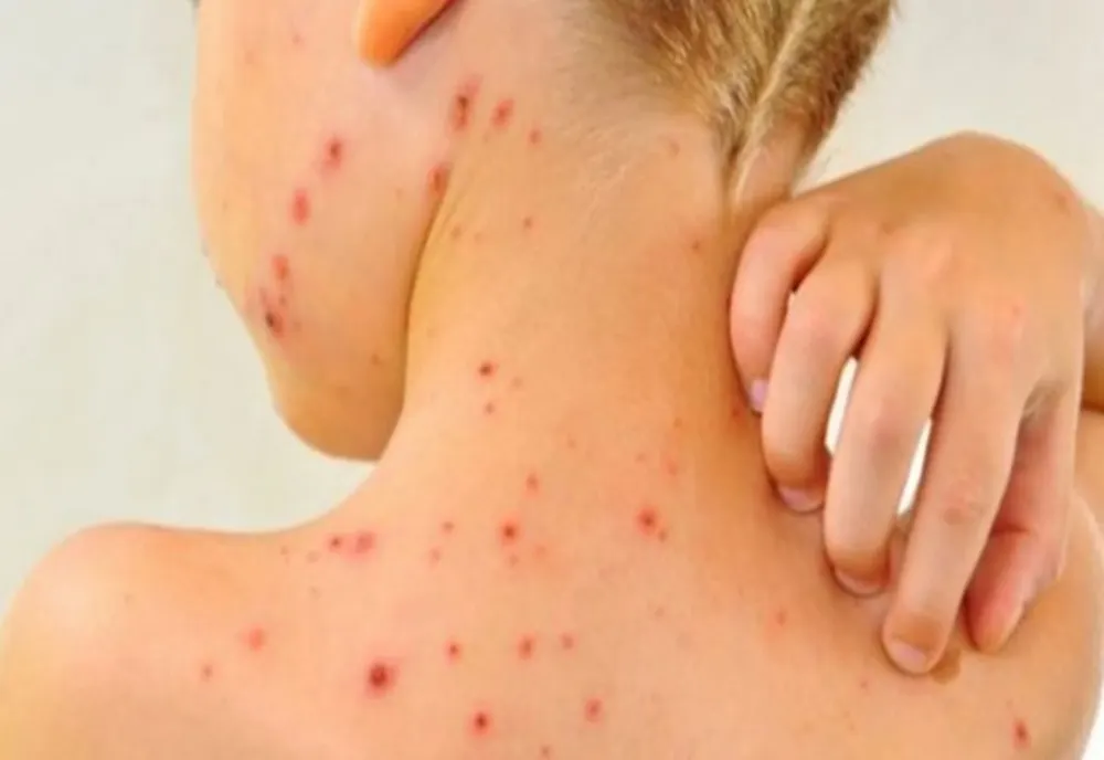 INSP: PESTE 1.000 DE CAZURI DE RUJEOLĂ ÎN ULTIMĂ LUNĂ DIN 2024