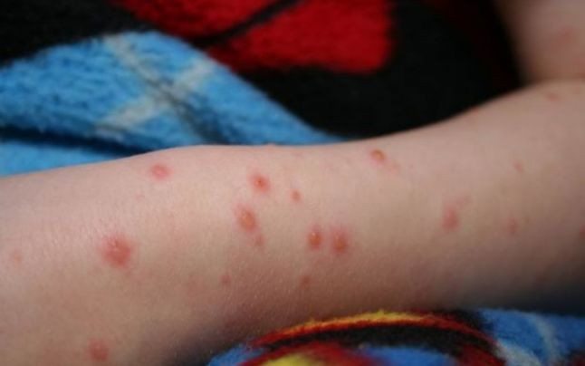 102 cazuri de rujeolă în ultima săptămână, dintre care unul la Brăila