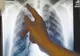 ROMÂNIA, PE PRIMUL LOC ÎN UE LA INCIDENȚA TUBERCULOZEI